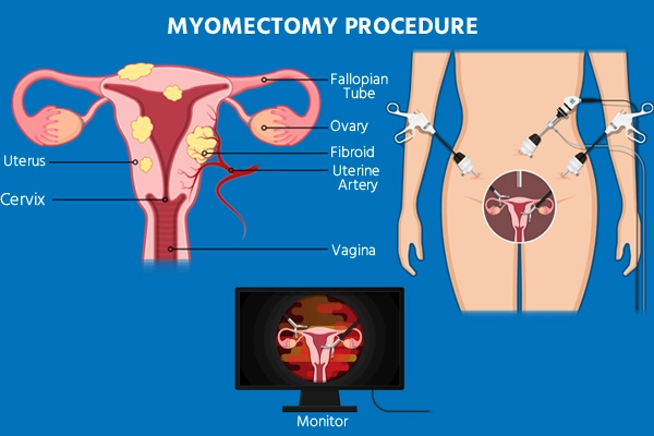 Myomectomy Procedure