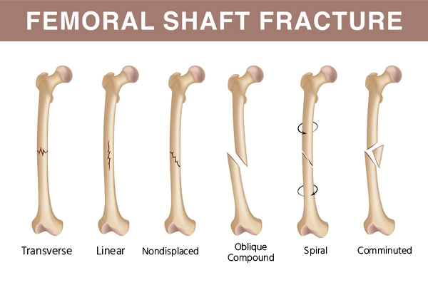 orif fracture shaft of femur