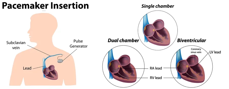 pacemaker implantation