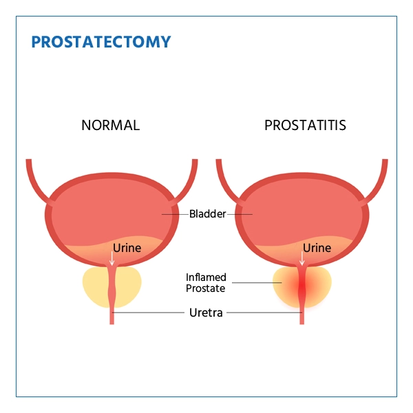 Prostatectomies Procedure