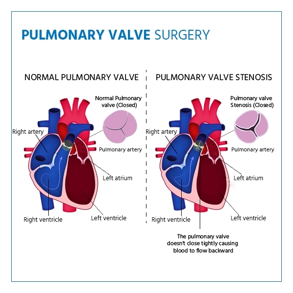 pulmonary valve surgery