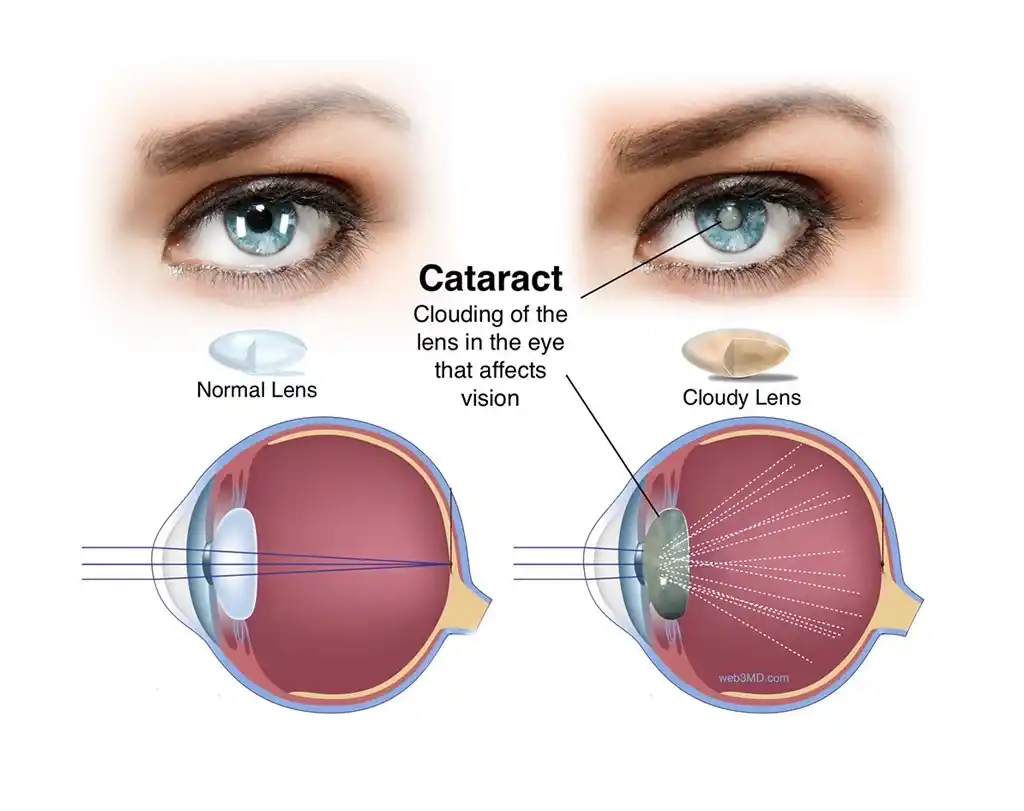 Recovery after Cataract Surgery