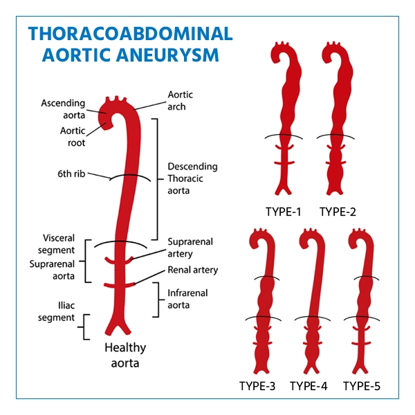 thoracoabdominal aortic aneurysm