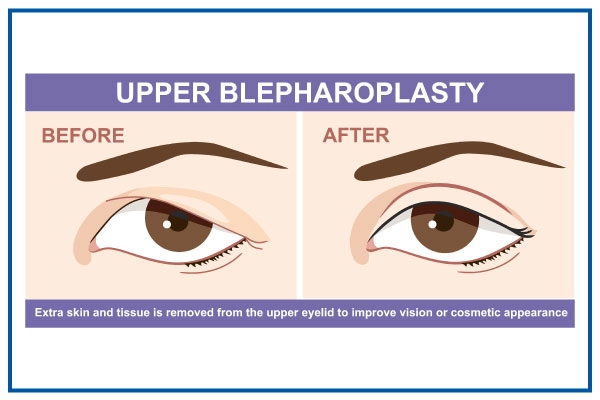 upper-blepharoplasty