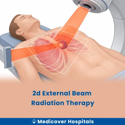2D External Beam Radiation Therapy