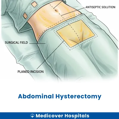 Abdominal Hysterectomy