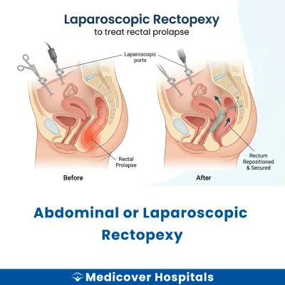 Abdominal Or Laparoscopic Rectopexy