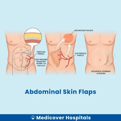 Abdominal Skin Flaps