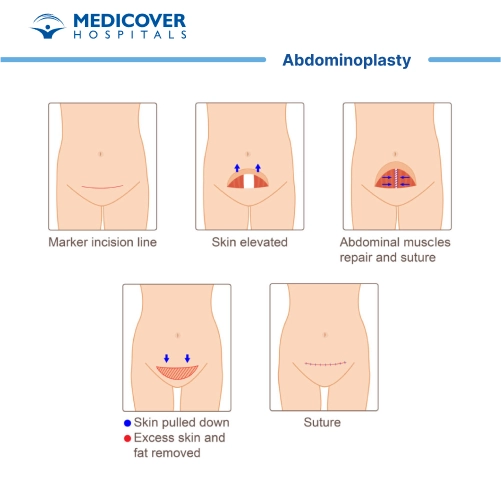 Abdominoplasty or Tummy Tuck surgery
