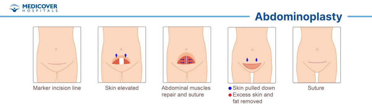 Abdominoplasty or Tummy Tuck surgery