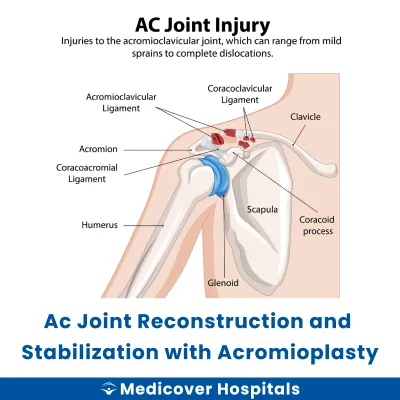 Ac Joint Reconstruction and Stabilization With Acromioplasty