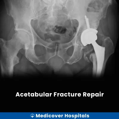 Acetabular Fracture Repair