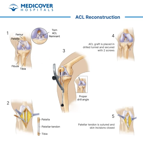 ACL Reconstruction Procedure