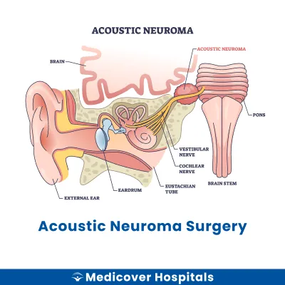 Acoustic Neuroma Surgery