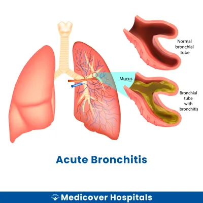Acute Bronchitis