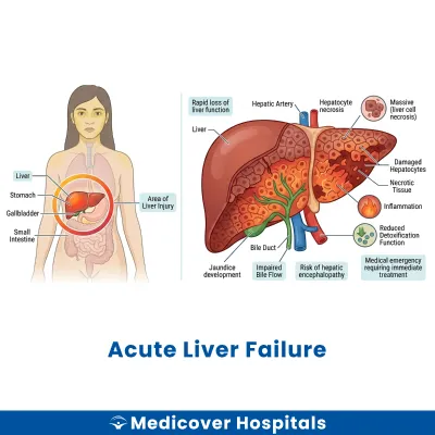 Acute Liver Failure