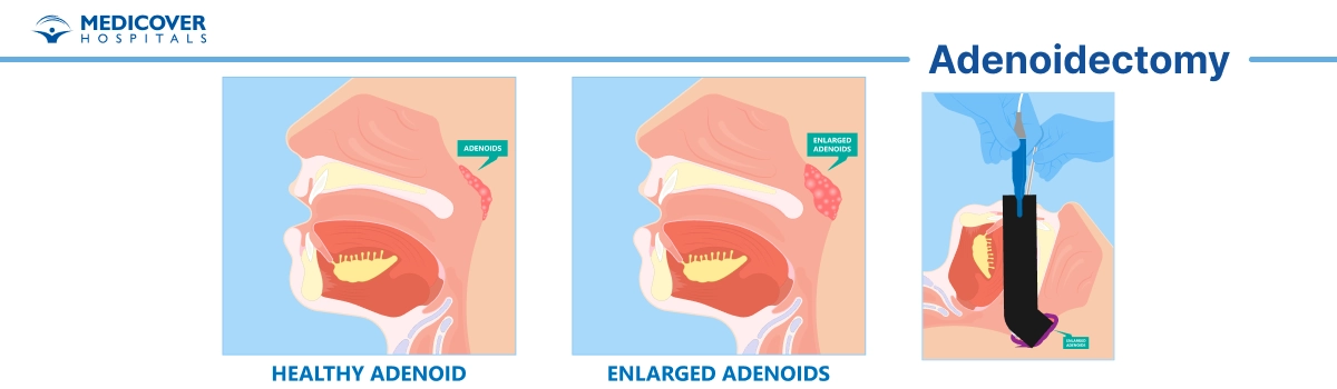 Adenoidectomy or adenoid removal surgery