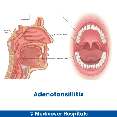 Adenotonsillitis