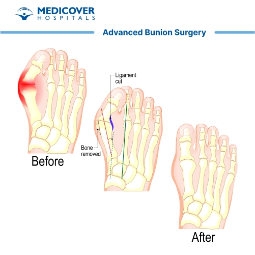 Bunion surgery or hallux valgus correction surgery