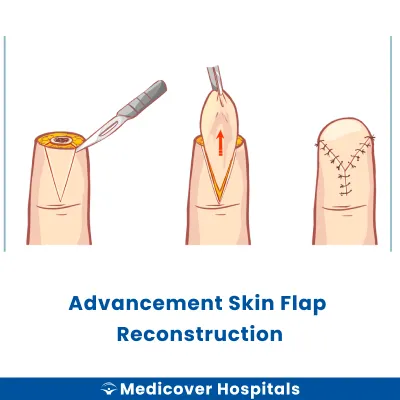 Advancement Skin Flap Reconstruction