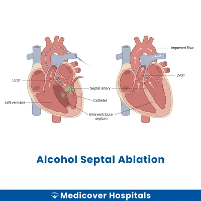 Alcohol Septal Ablation