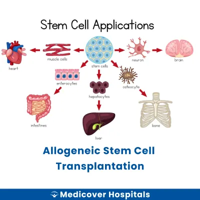 Allogeneic Stem Cell Transplantation