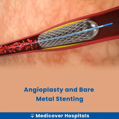 Angioplasty and Bare Metal Stenting