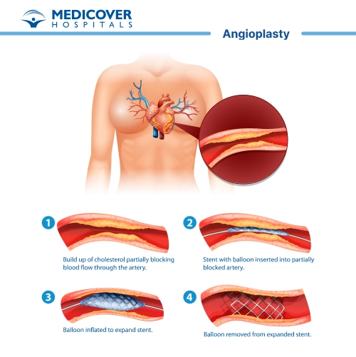 Angioplasty a MIS Procedure