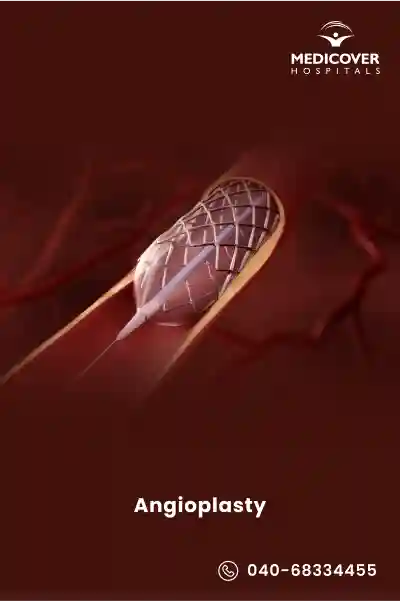 angioplasty-procedure
