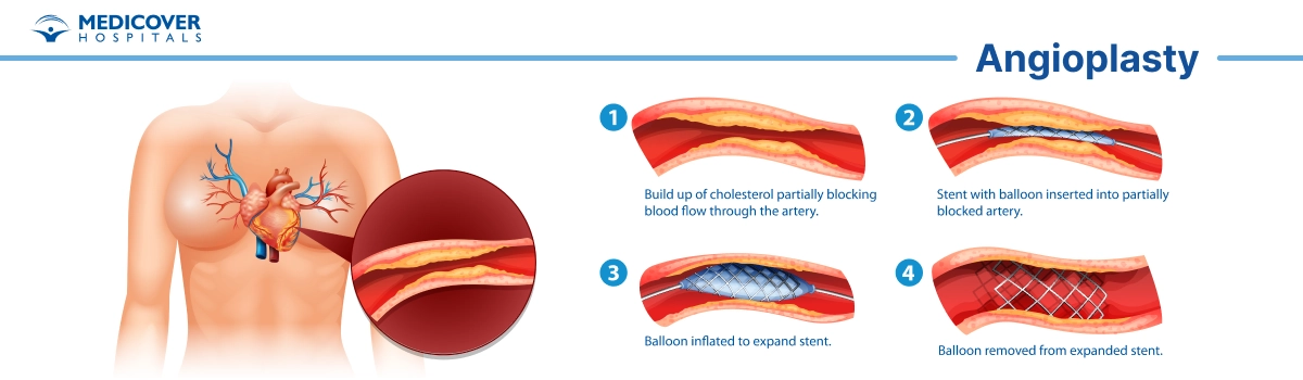 angioplasty procedure