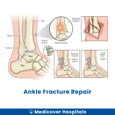 Ankle Fracture Repair