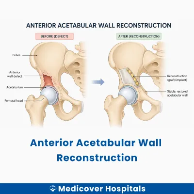 Anterior Acetabular Wall Reconstruction