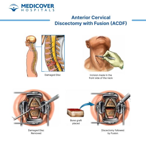 Anterior cervical discectomy and fusion surgery