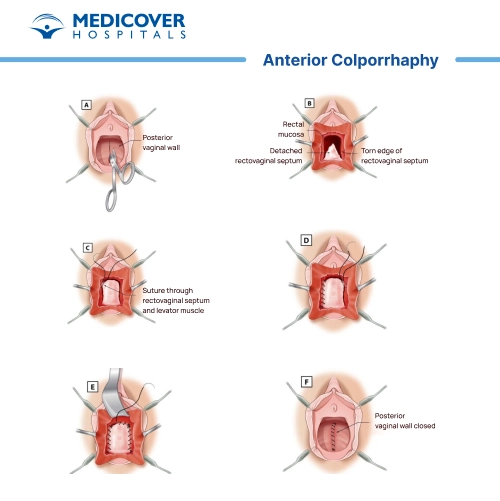 Anterior colporrhaphy procedure