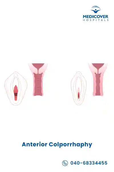 anterior-colporrhaphy-procedure