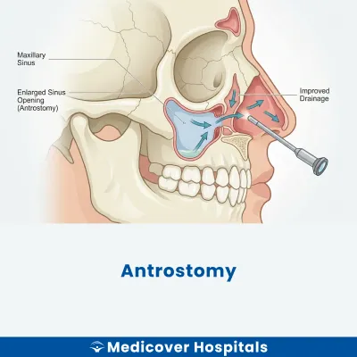 Antrostomy