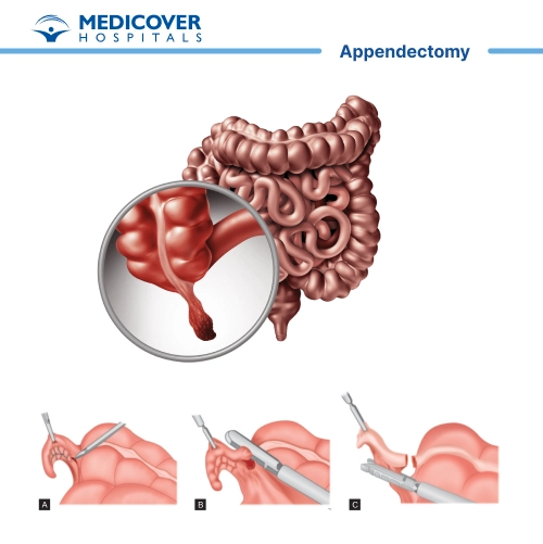 Appendectomy or appendicitis surgery