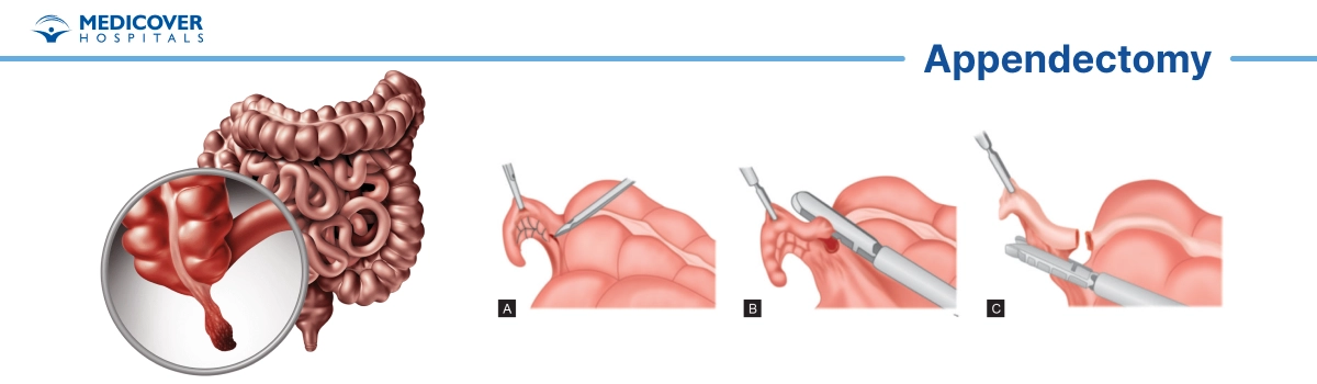 Appendectomy or appendicitis surgery