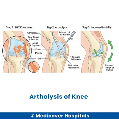 Artholysis of Knee