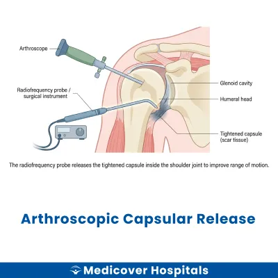 Arthroscopic Capsular Release
