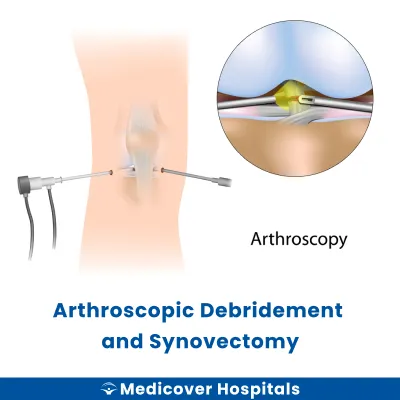 Arthroscopic Debridement and Synovectomy