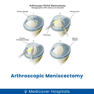 Arthroscopic Meniscectomy
