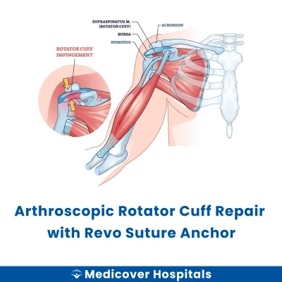 Arthroscopic Rotator Cuff Repair With Revo Suture Anchor