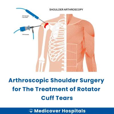 Arthroscopic Shoulder Surgery for The Treatment of Rotator Cuff Tears