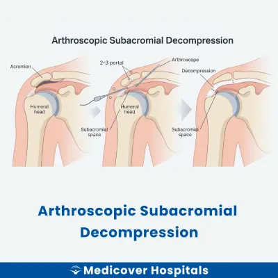 Arthroscopic Subacromial Decompression