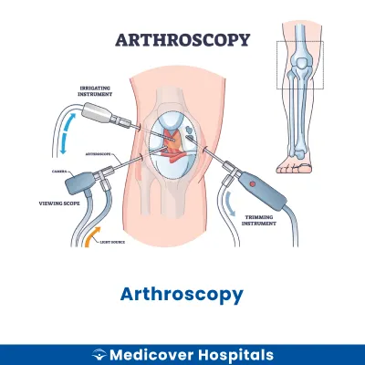 Arthroscopy