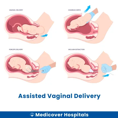 Assisted Vaginal Delivery