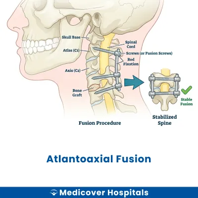 Atlantoaxial Fusion