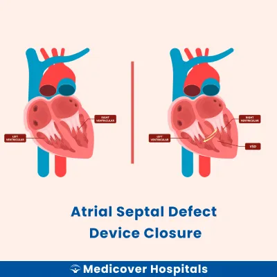 Atrial Septal Defect Device Closure