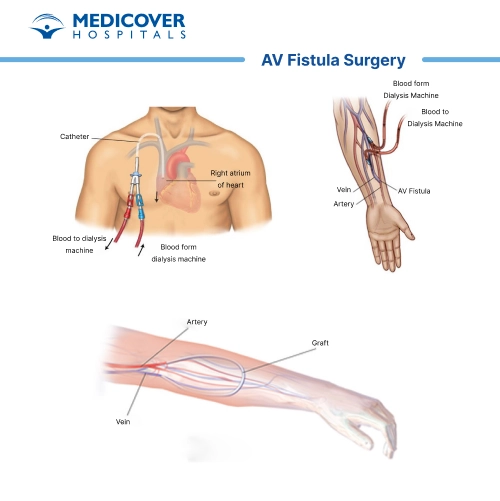 AV fistula surgery
